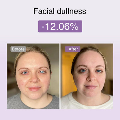 DermRays FusionGlow Multi-Functional Microcurrent Facial Toning Device