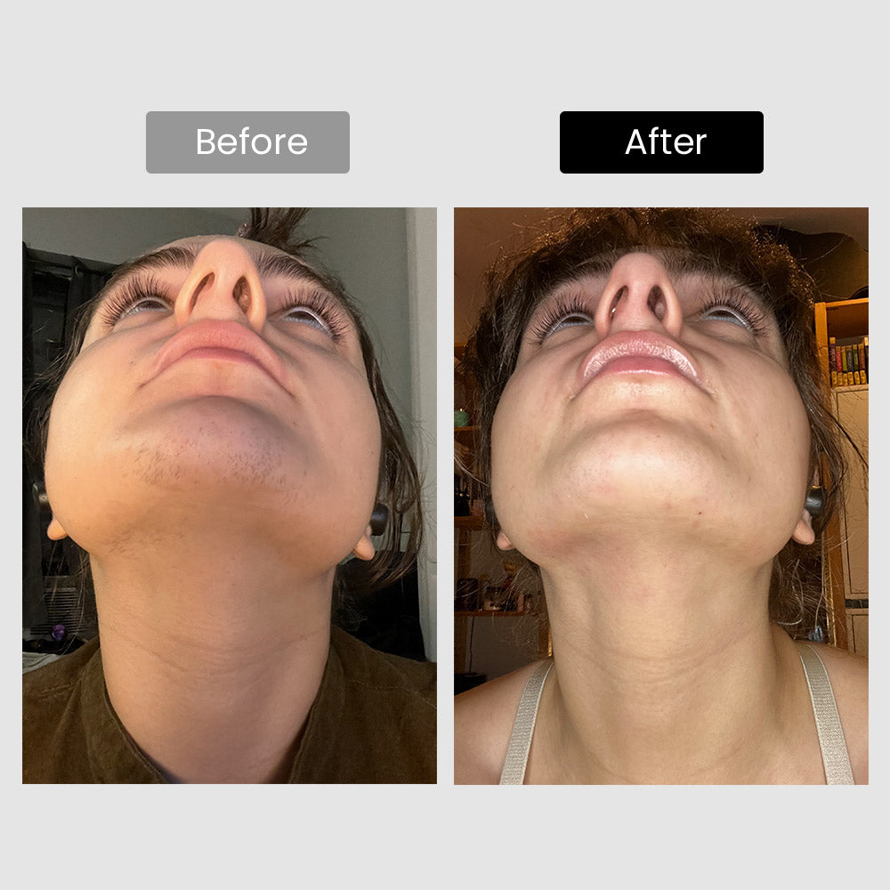 DermRays V4S Diode Laser Hair Removal, 810nm, Specifically For Sensitive Skin