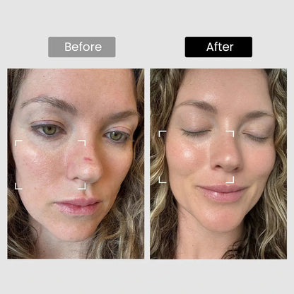 DermRays Revive Skincare Laser for Anti-Aging, Glow Like Never Before